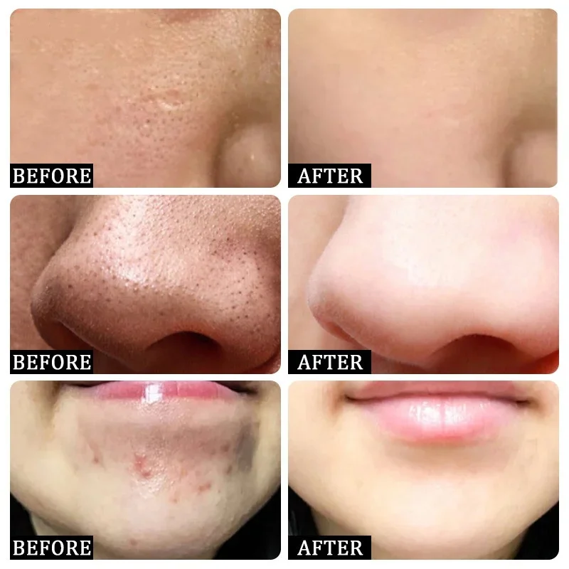 Salicylic Acid Pore Clearing C - Azelaic Acid Cream recensie en prijs