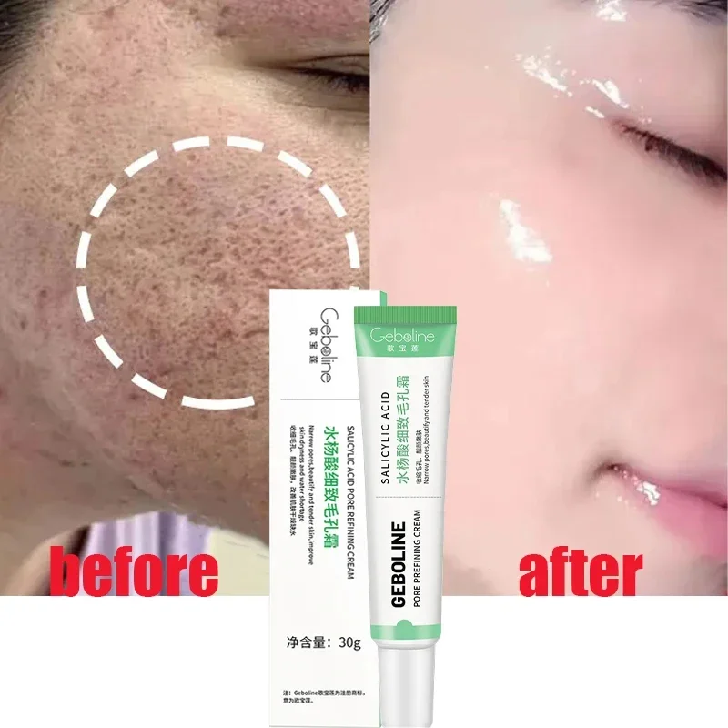 Salicylic Acid Pore Shrinking  - Azelaic Acid Cream recensie en prijs