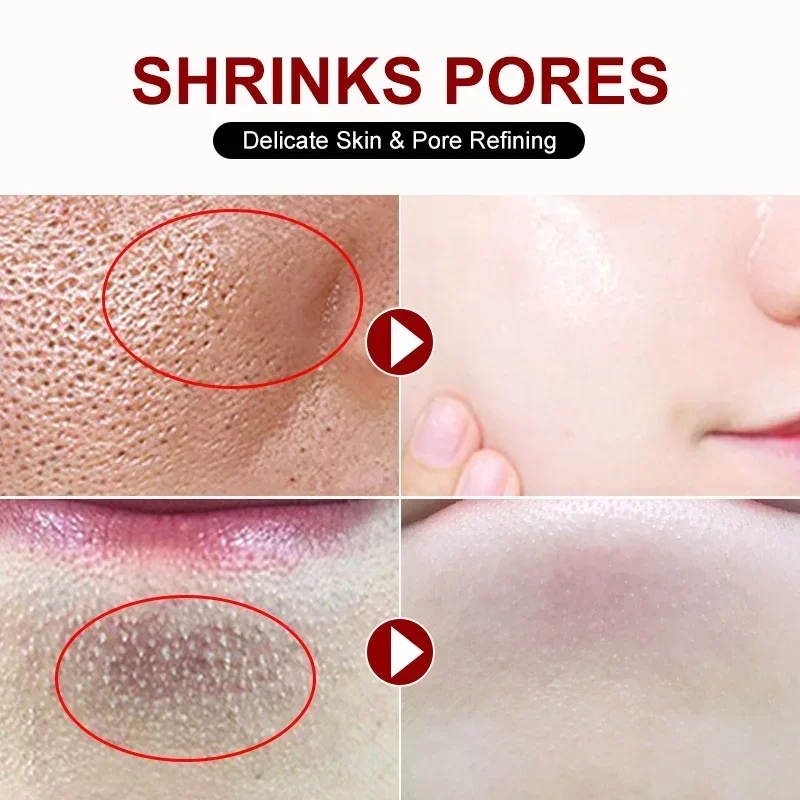 Salicylic Acid Pore Shrinking  - Azelaic Acid Cream recensie en prijs