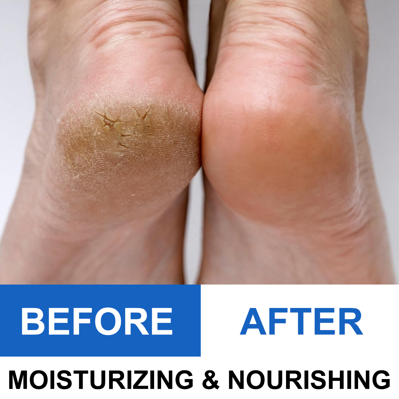 40% Urea Foot Cream Stick - Mo - Azelaic Acid Cream recensie en prijs